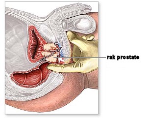 Slika 3. - Transuretralna resekcija prostate (TURP).