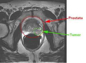 Slika 2. - CT prikaz prostate i raka prostate