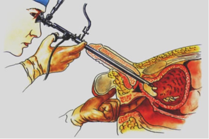 Slika 1. - digitorektalni pregled i rak prostate